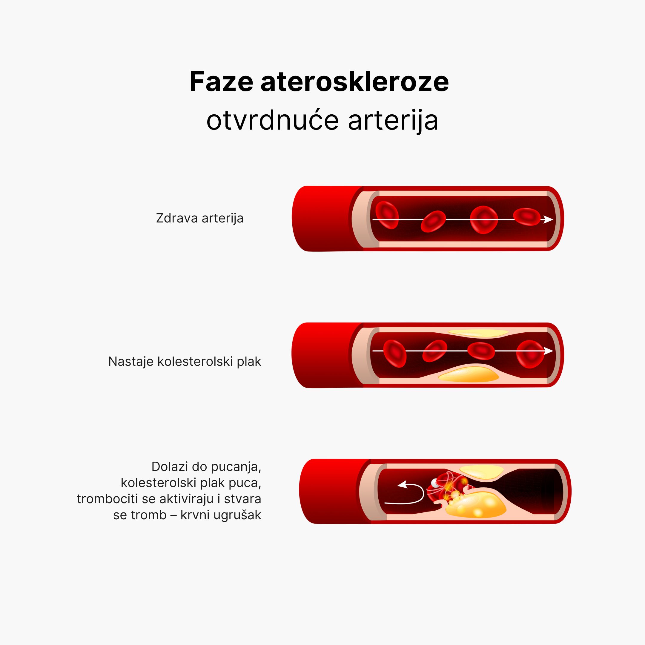 (Chorvatština) Arterioskleróza 